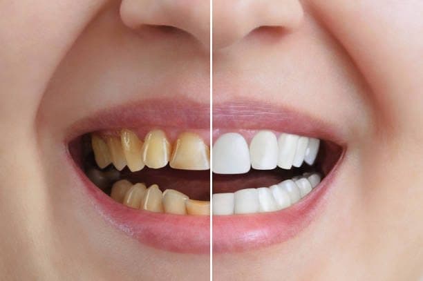 Smile transformation — before and after cosmetic dentistry