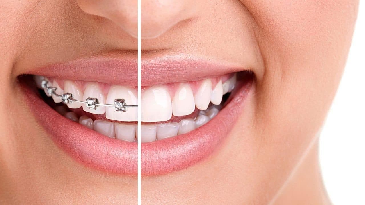 Braces and clear aligner orthodontic treatment